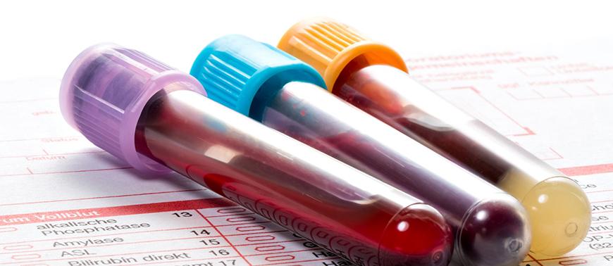 A Possible Blood Test To Detect Alzheimer's Disease On The Horizon